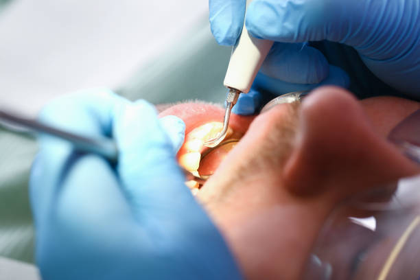 Best Emergency Tooth Extraction in Mcadoo, PA