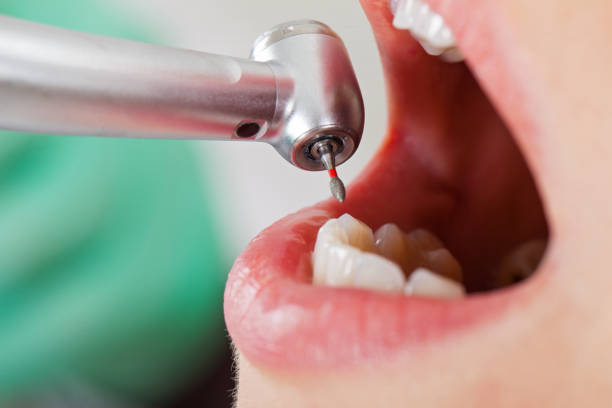 Best Emergency Tooth Extraction in Mcadoo, PA